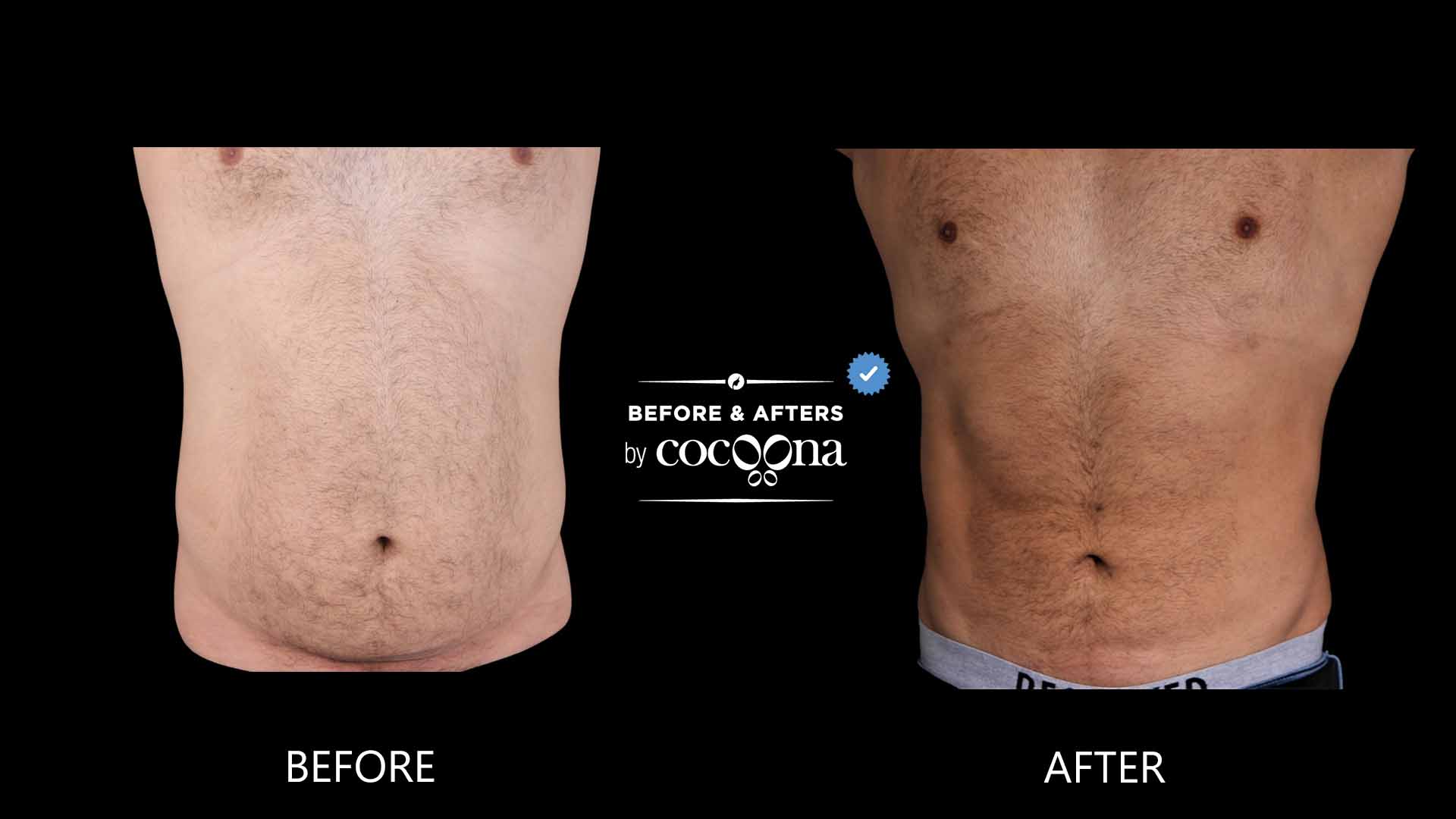 Lipo abdomen 1 year post op