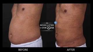 Lipo abdomen and flanks 1 month and 3 days post op copy 320x180 1
