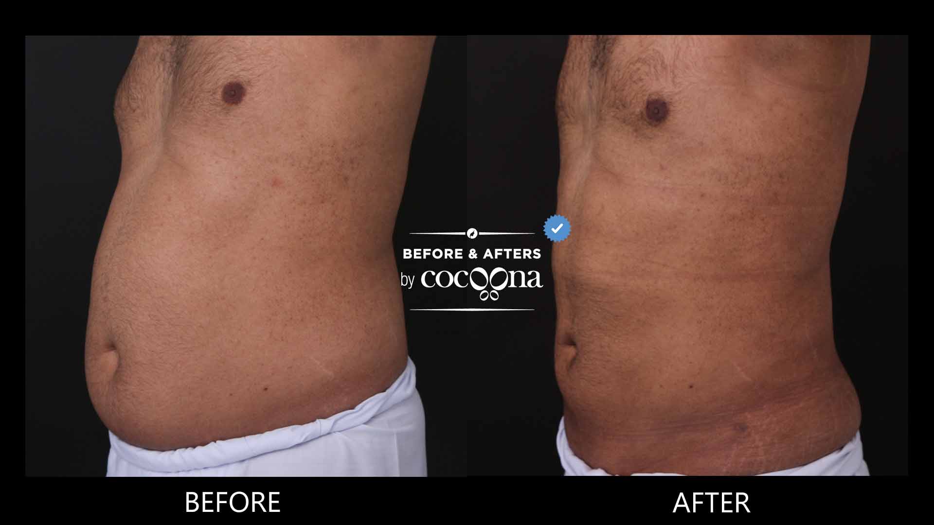 Lipo abdomen and flanks 1 month and 3 days post op