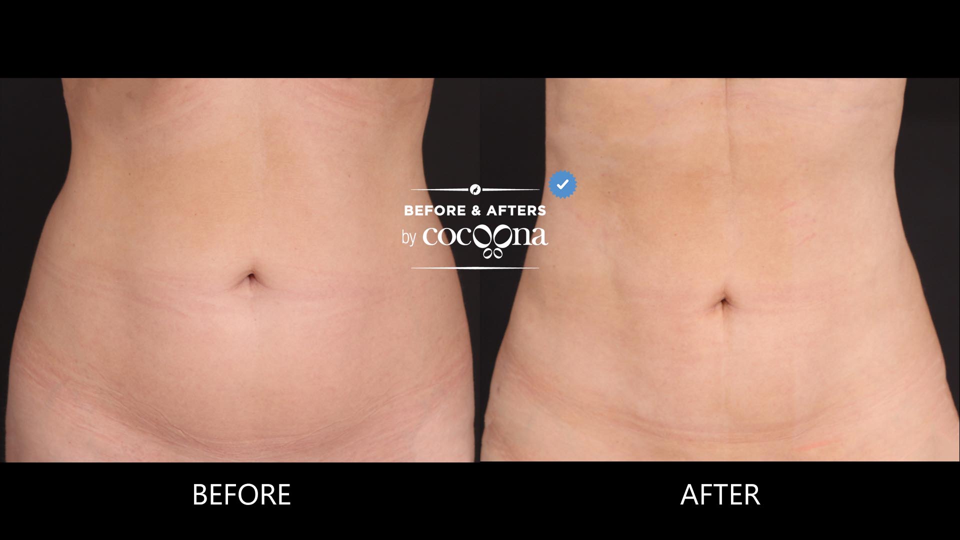 Lipo abdomen and flanks 3 months and 3 weeks post op