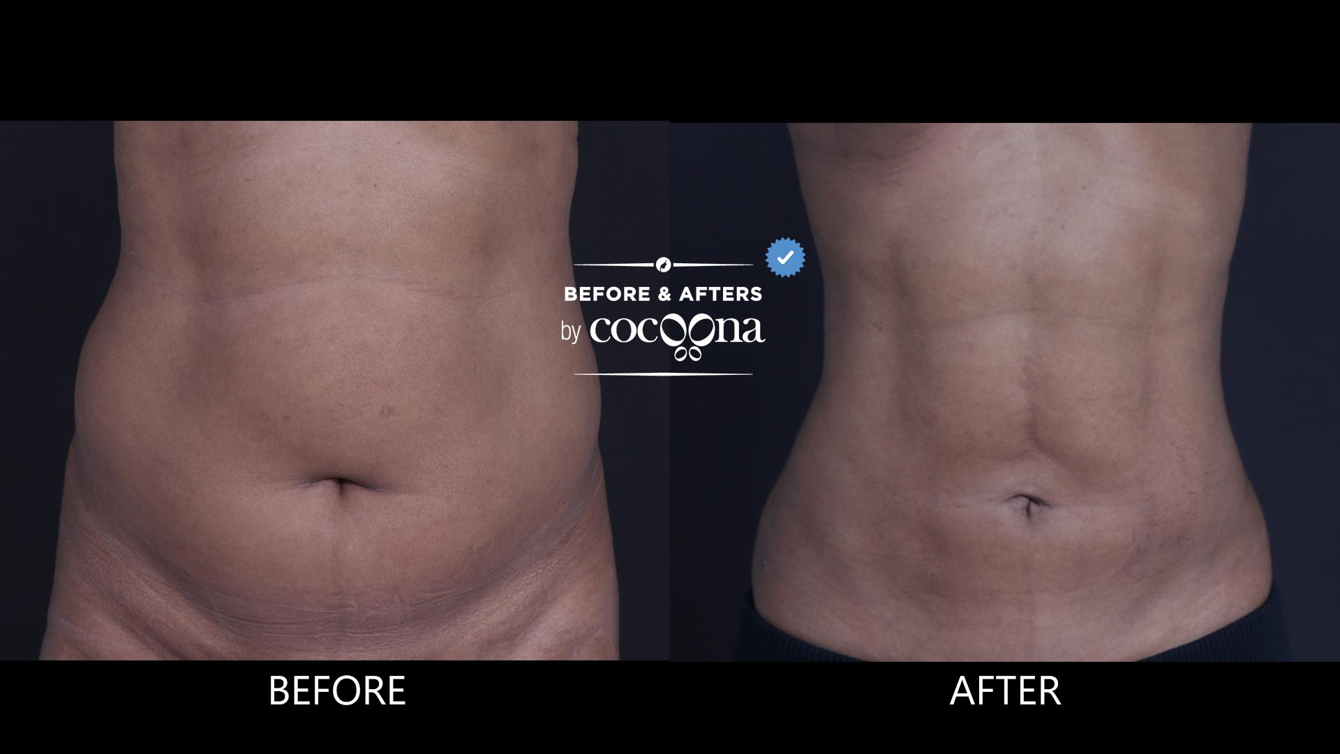 Lipo abdomen and flanks 6 months post op