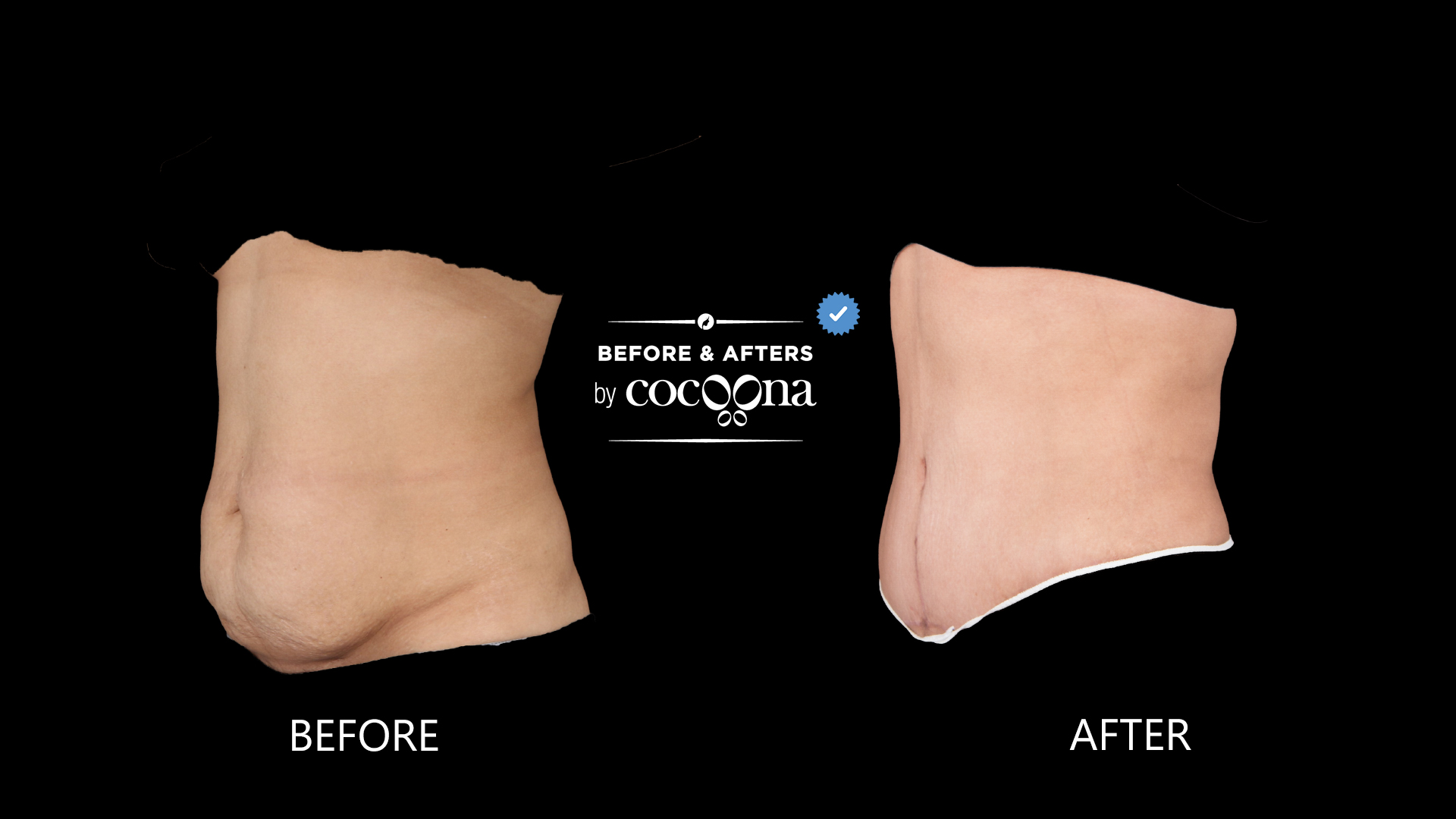 lipo-abdominoplasty-3-months-post-op-2.jpg