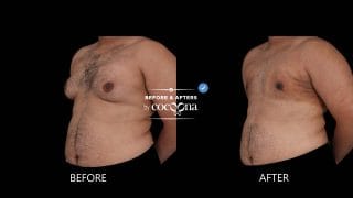 Lipo chest 3 weeks post op 320x180 1