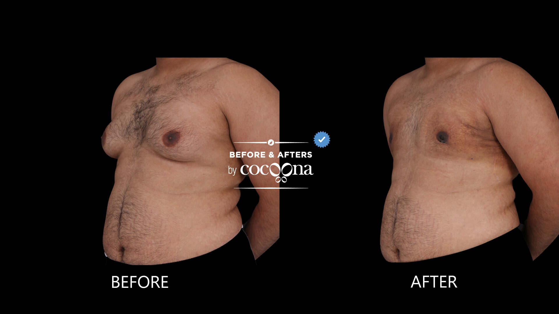 Lipo chest 3 weeks post op