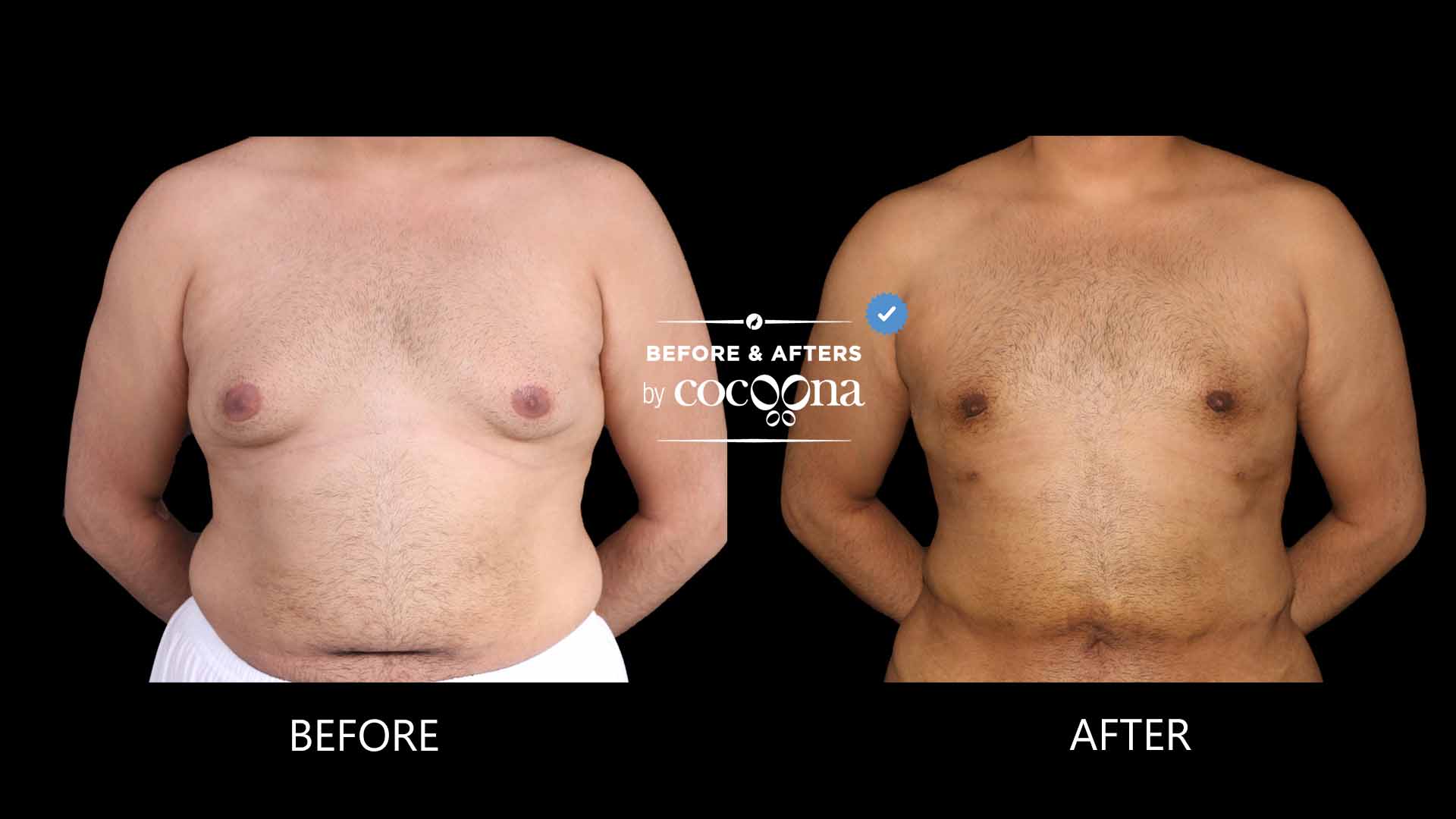 Lipo chest 4 months post op