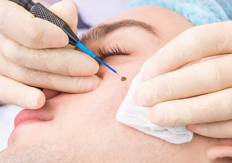 RF mole removal needle electrode dermatosurgery procedure