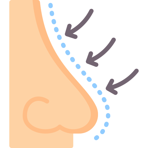 Rhinoplasty procedure illustration