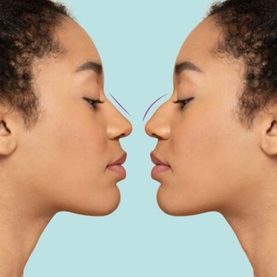 Rhinoplasty Surgery