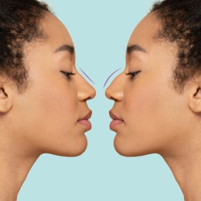 Rhinoplasty Rhinoplasty Surgery