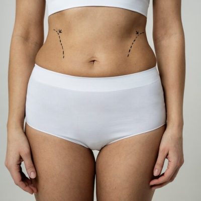 Tummy Tuck-slider